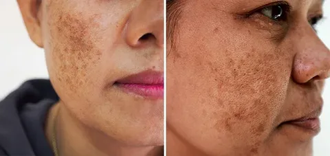 Hyperpigmentation is one of the most common skin concerns