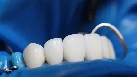 Why DentPrime Has Become a Top Choice for Zirconium Crowns in Turkey